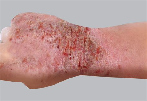 eczema en la piel - pastillas para la gripa
